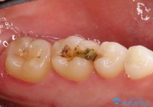 詰め物が外れた セラミックによる精密な修復の治療前