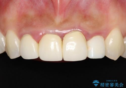 前歯のオールセラミック　腫れている歯肉が改善の症例 治療前