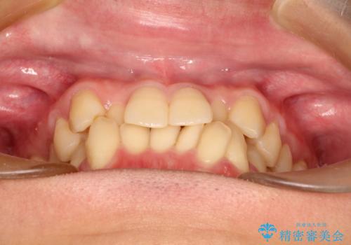 前歯のガタガタの矯正 下顎の前歯を1本抜歯してのインビザライン矯正の治療前