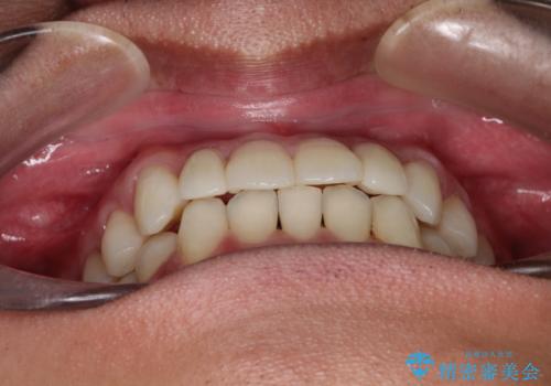 前歯のガタガタの矯正 下顎の前歯を1本抜歯してのインビザライン矯正の治療後