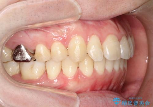 前歯でものが噛み切れない インビザラインによるオープンバイトの治療の症例 治療後