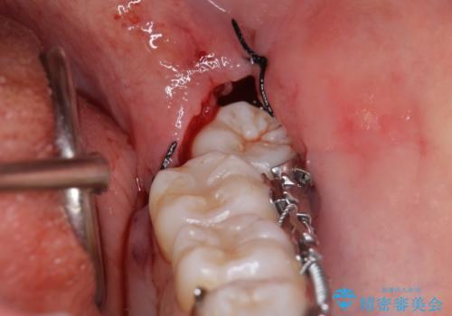 受け口 親知らずを取り込む矯正治療の治療中