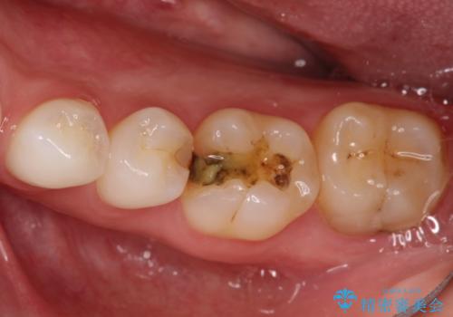 詰め物が外れた セラミックによる精密な修復の治療前