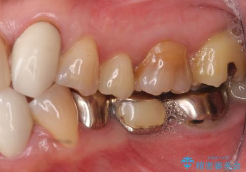 オールセラミッククラウン・セラミックインレー 口腔内全体の見た目の改善の治療前