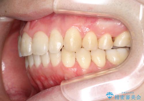 前歯でものが噛み切れない　インビザラインによるオープンバイトの治療の治療後