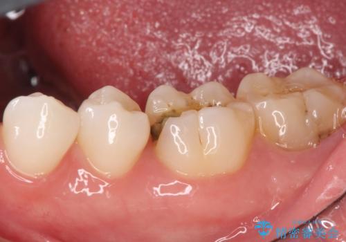 詰め物が外れた セラミックによる精密な修復の症例 治療前