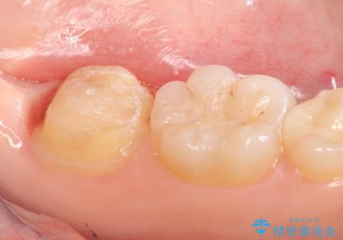 オールセラミッククラウン 奥歯の虫歯・深いポケットの除去の治療前