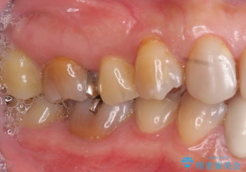 オールセラミッククラウン・セラミックインレー 口腔内全体の見た目の改善の治療前
