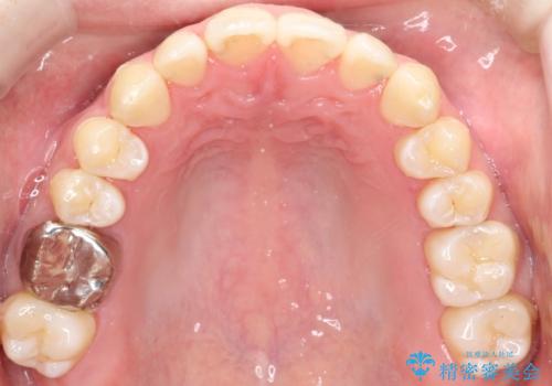 前歯でものが噛み切れない インビザラインによるオープンバイトの治療の治療後