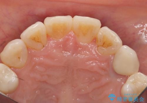 犬歯の変色 マウスピースで手軽にエクストリュージョン 歯ぐきの炎症をおさめますの治療後