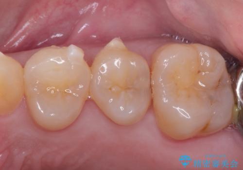 虫歯の治療。ゴールドインレーによる治療の症例 治療前