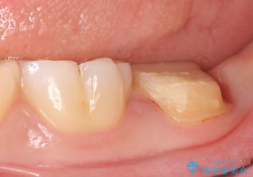 オールセラミッククラウン 奥歯の虫歯・深いポケットの除去の治療前