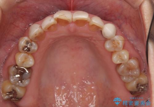 オールセラミッククラウン・セラミックインレー 口腔内全体の見た目の改善の治療前