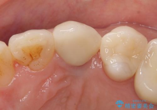 犬歯の変色　マウスピースで手軽にエクストリュージョン　歯ぐきの炎症をおさめますの治療後