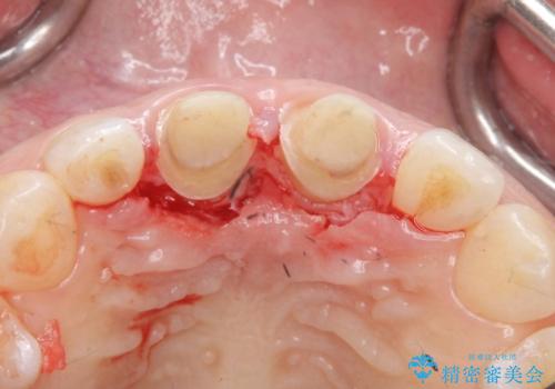 口ゴボでお悩みの方必見! 不自然なセラミックをやり直す矯正 セラミックだけでは、口元は下がりません。の治療中
