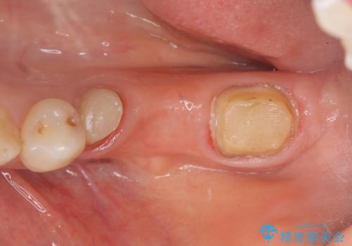 オールセラミッククラウン 欠損補綴と再生療法による深いポケットの改善の治療前
