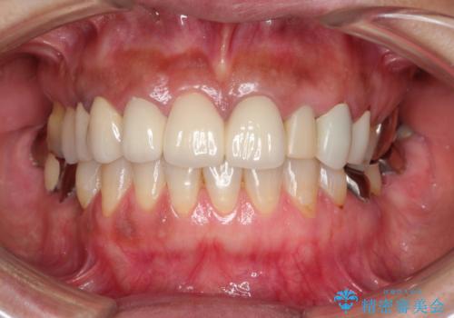 汚れてしまった前歯の仮歯 オールセラミッククラウンにて自然にの治療前