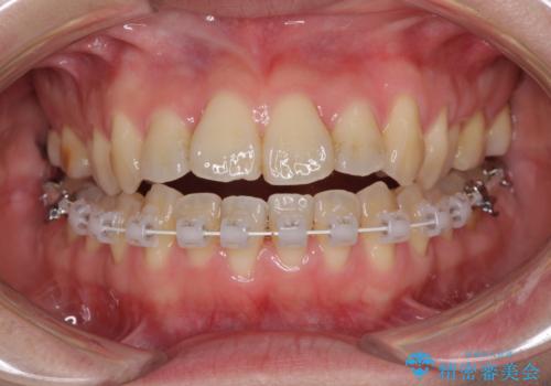 ハーフリンガル 反対咬合の改善の治療中