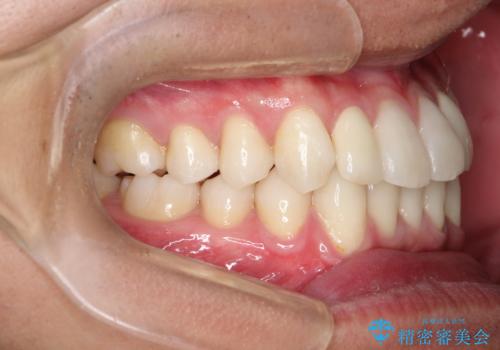 前歯のガタガタの矯正 下顎の前歯を1本抜歯してのインビザライン矯正の治療後