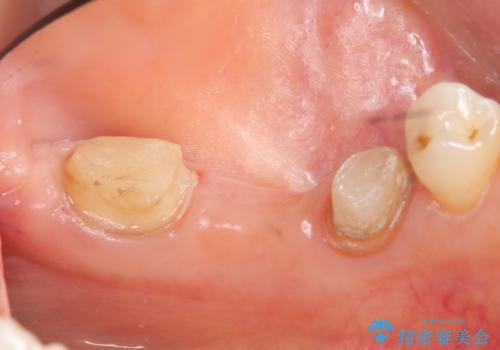 オールセラミッククラウン 欠損補綴と再生療法による深いポケットの改善の治療前