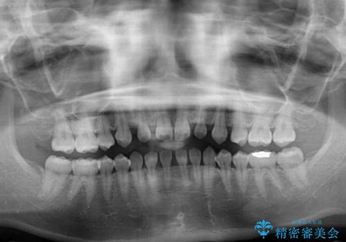矯正治療とインプラント治療を同時に 総合歯科診療の治療前