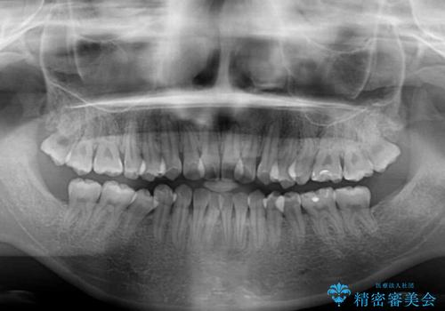 ハーフリンガル 反対咬合の改善の治療前