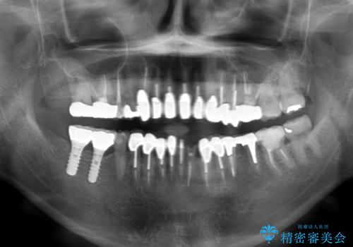 この際全てをしっかりと治療したい 総合歯科治療の治療前
