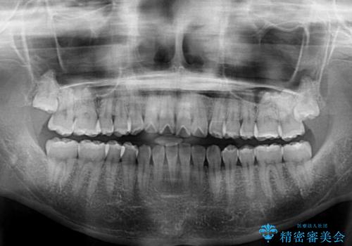 オープンバイトのインビザラインを用いた再矯正 の治療前