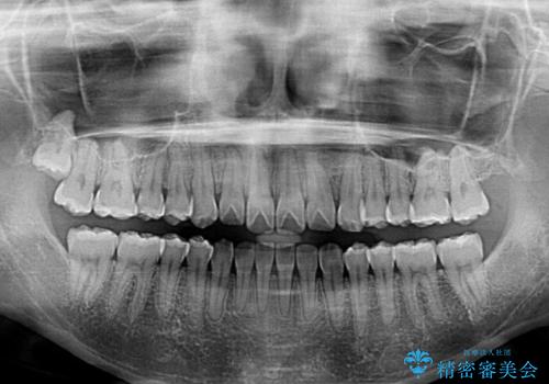 オープンバイトのインビザラインを用いた再矯正 の治療後