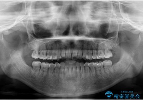 ハーフリンガル 反対咬合の改善の治療後