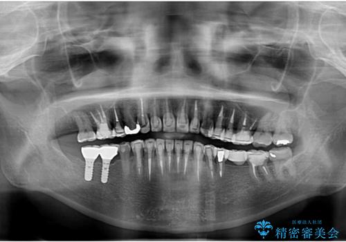 この際全てをしっかりと治療したい 総合歯科治療の治療中