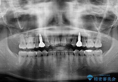 矯正治療とインプラント治療を同時に 総合歯科診療の治療後