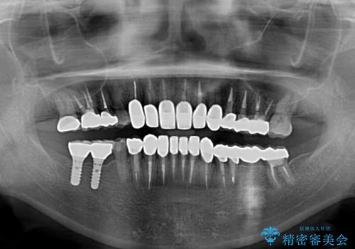 この際全てをしっかりと治療したい 総合歯科治療の治療後