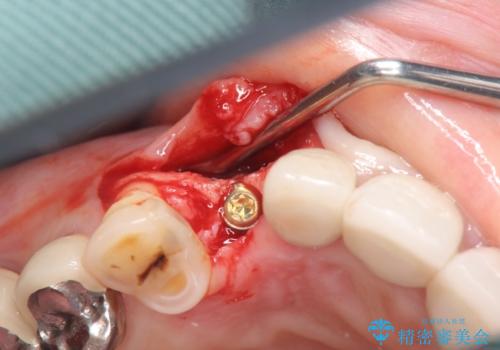 クラウン下に再発した深い虫歯 インプラントによる機能回復の治療中