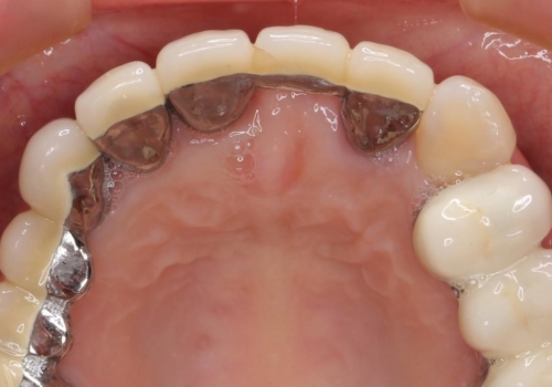 前歯ブリッジのやりかえの治療前