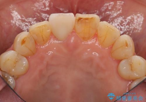 天然歯を模した ハイグレードオールセラミッククラウンの治療後