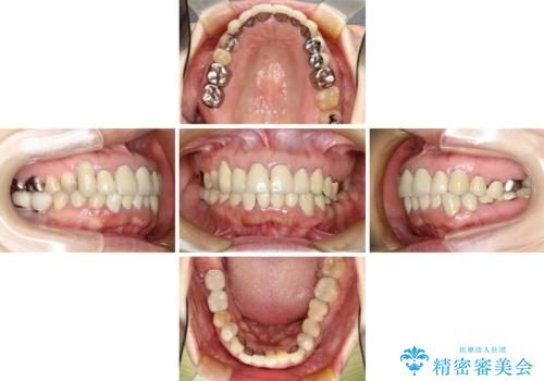 この際全てをしっかりと治療したい 総合歯科治療の治療前