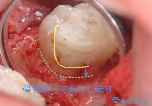 他院で次に虫歯になったら治せないと言われた 歯周外科手術でしっかり治療(APF)の治療中