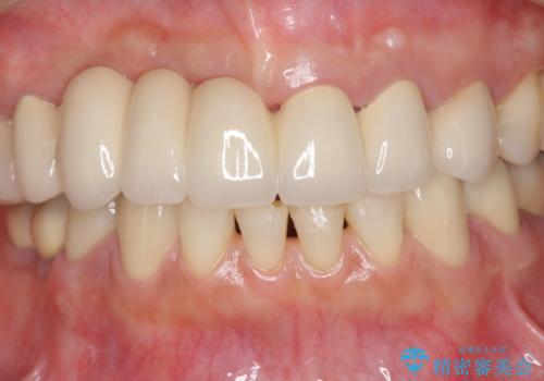 咬合性外傷による歯槽骨吸収 ブリッジ補綴の治療後