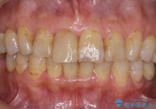 天然歯を模した ハイグレードオールセラミッククラウンの治療前