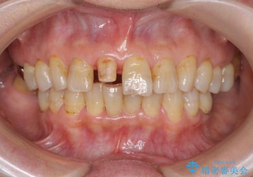 天然歯を模した ハイグレードオールセラミッククラウンの治療中