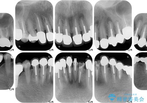 この際全てをしっかりと治療したい 総合歯科治療の治療前