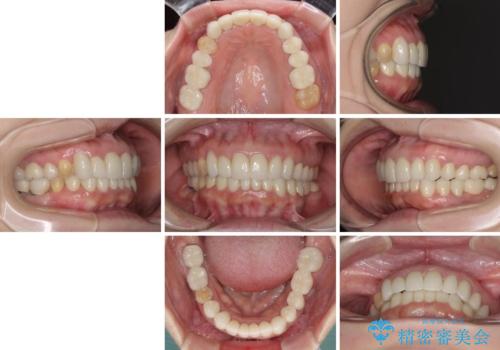 この際全てをしっかりと治療したい 総合歯科治療の治療後