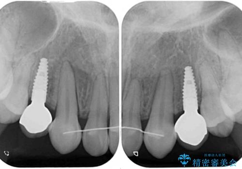 矯正治療とインプラント治療を同時に 総合歯科診療の治療後