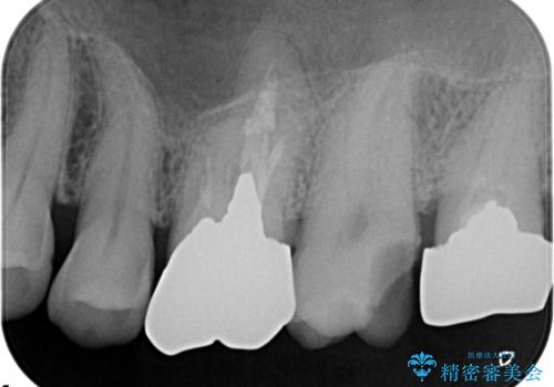 ゴールドインレーによる修復治療の治療前