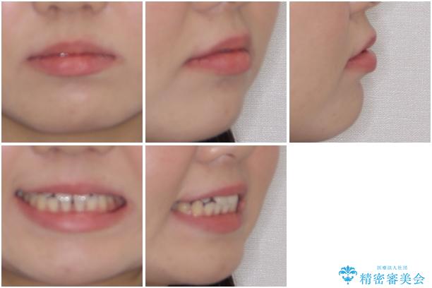 矯正治療とインプラント治療を同時に　総合歯科診療の治療前（顔貌）