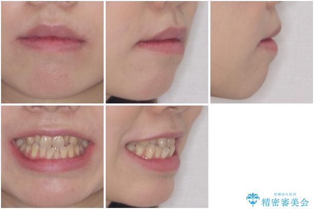 ハーフリンガル 反対咬合の改善の治療前(顔貌)