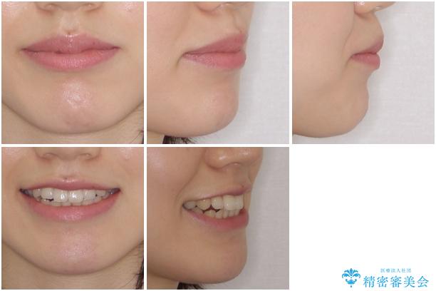 オープンバイトのインビザラインを用いた再矯正 の治療前(顔貌)