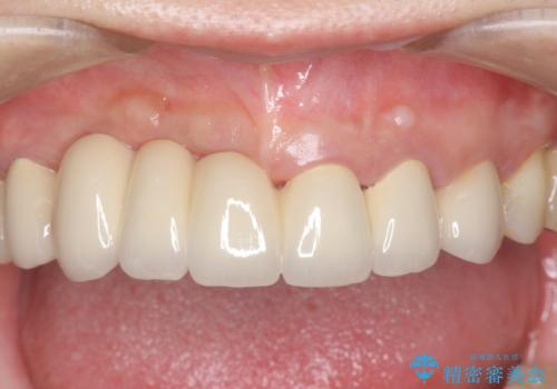 咬合性外傷による歯槽骨吸収 ブリッジ補綴の治療後