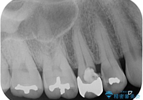 前歯のすきっぱ&奥歯の虫歯 セラミッククラウンで徹底的に治すの治療前